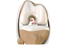 Meniscal Tears