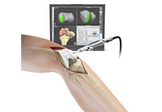 Computer Navigation for Total Knee Replacement