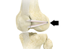 Medial Patellofemoral Ligament Reconstruction