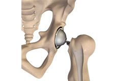 Hip Replacements
