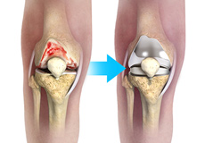 What is New in Knee Replacement?